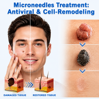 ✨2-in-1 Microneedle & Hydrocolloid Patch🍀| Removes Raised Moles, Acne, Flat Warts & Skin Tags | Helps Improve Wrinkles, Scars & Blemishes