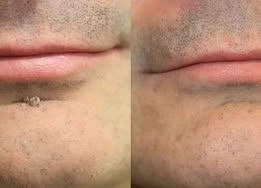 ✨2-in-1 Microneedle & Hydrocolloid Patch🍀| Removes Raised Moles, Acne, Flat Warts & Skin Tags | Helps Improve Wrinkles, Scars & Blemishes