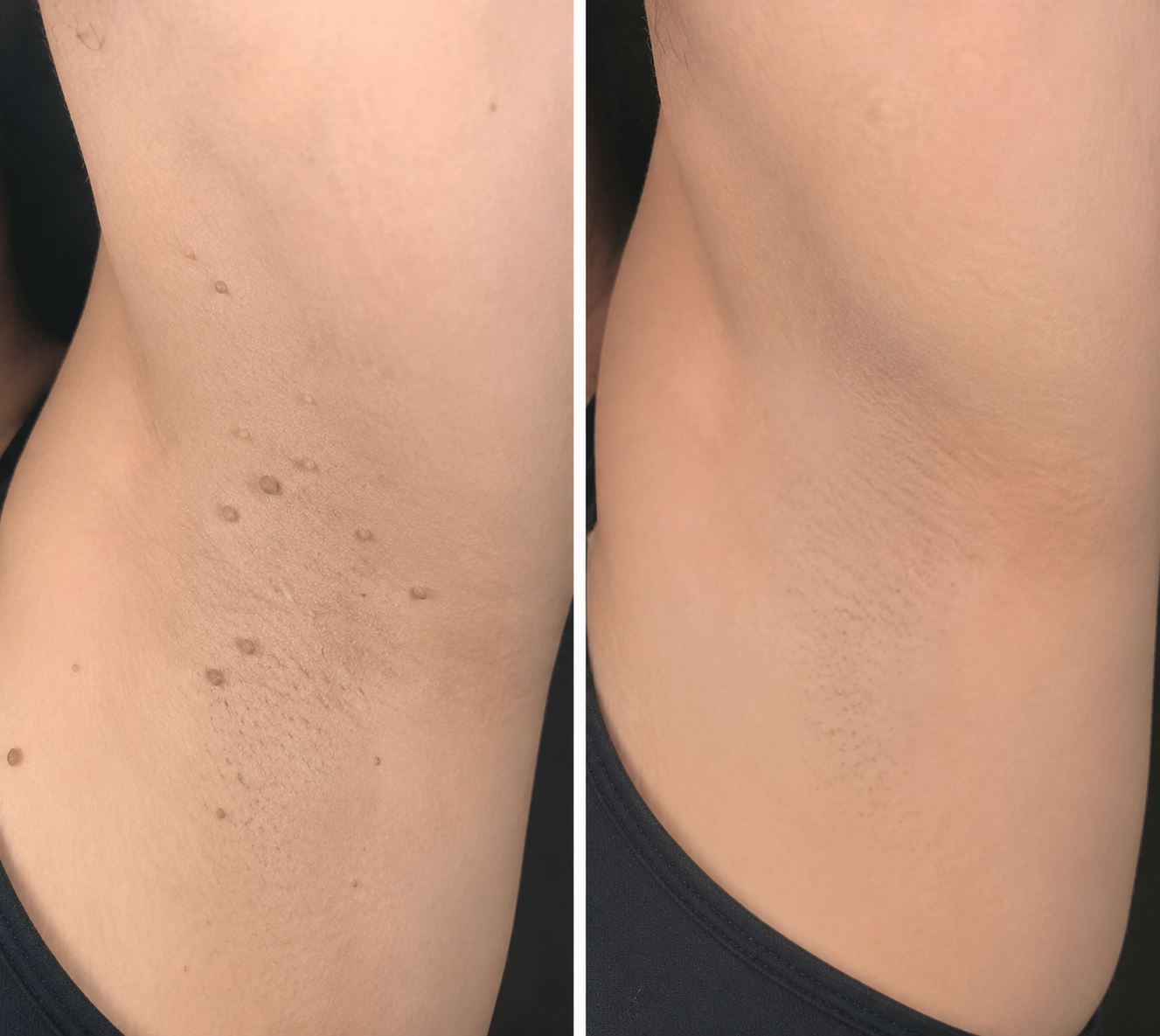 ✨2-in-1 Microneedle & Hydrocolloid Patch🍀| Removes Raised Moles, Acne, Flat Warts & Skin Tags | Helps Improve Wrinkles, Scars & Blemishes