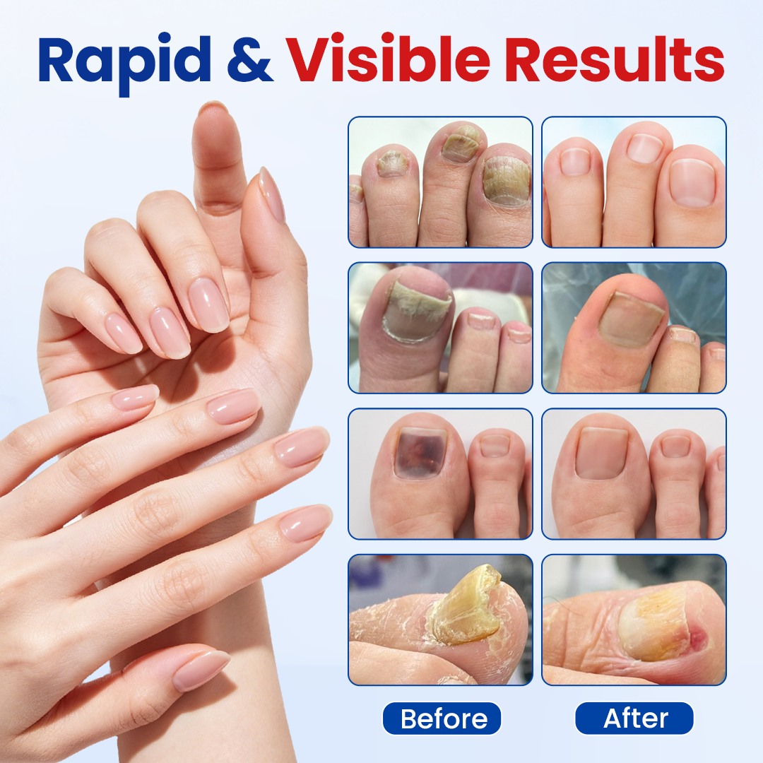 Fungal Nail Repair Patches