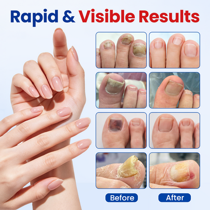Fungal Nail Repair Patches