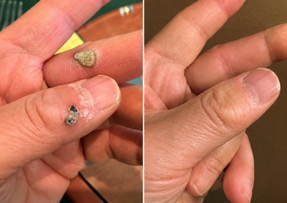 ✨2-in-1 Microneedle & Hydrocolloid Patch🍀| Removes Raised Moles, Acne, Flat Warts & Skin Tags | Helps Improve Wrinkles, Scars & Blemishes